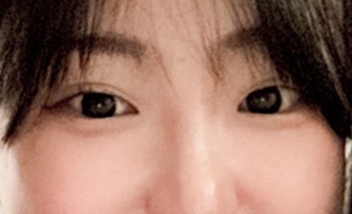 쌍꺼풀(자연유착) 후기