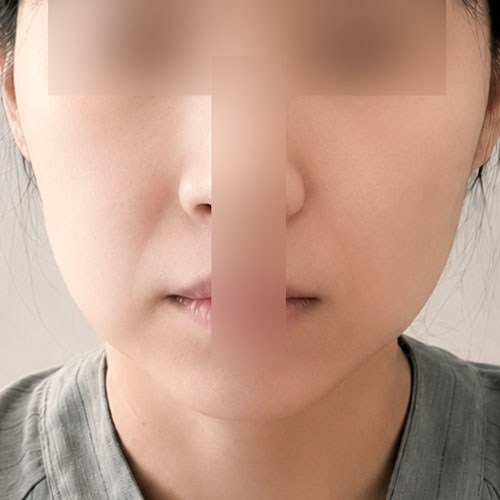 실리프팅 후기