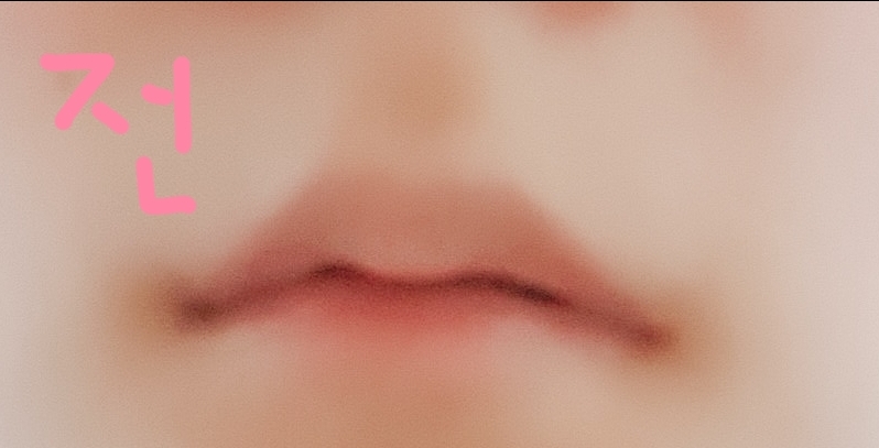 입꼬리성형 후기
