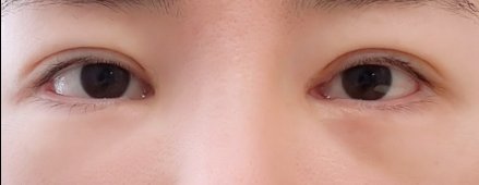 눈재수술 후기