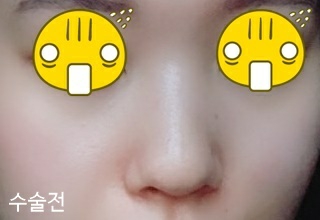 콧대(자가조직) 후기