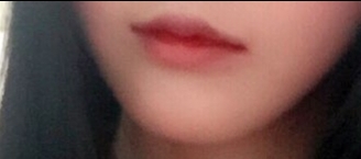 입꼬리성형 후기
