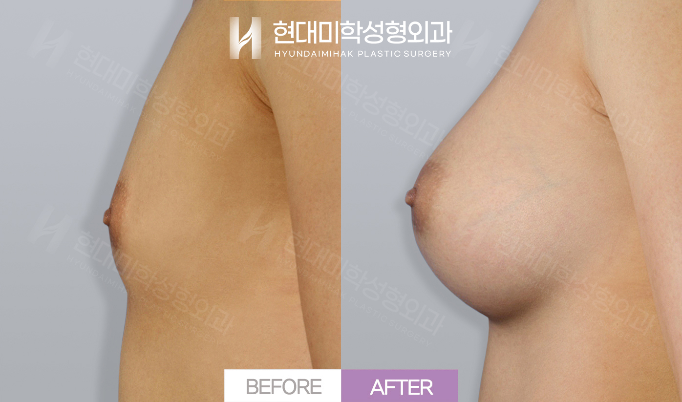 가슴확대(실리콘)