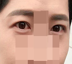 남자 쌍수 후기요ㅋㅋㅋ