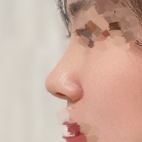 매부리코 수술 후기