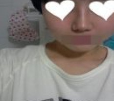 코수술했어요~~~