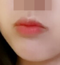 입꼬리성형하고 인기녀 ㅋㅋㅋ