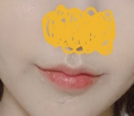 압꼬리수술 성공적 >_<