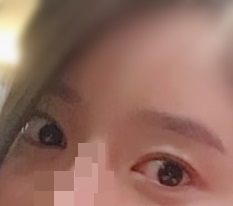 눈매교정 대만족합니다!