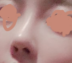 현대미학에서 코재수술하기를 정말 잘했네요~