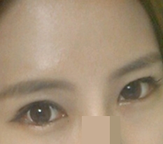 눈성형 후기입니돠