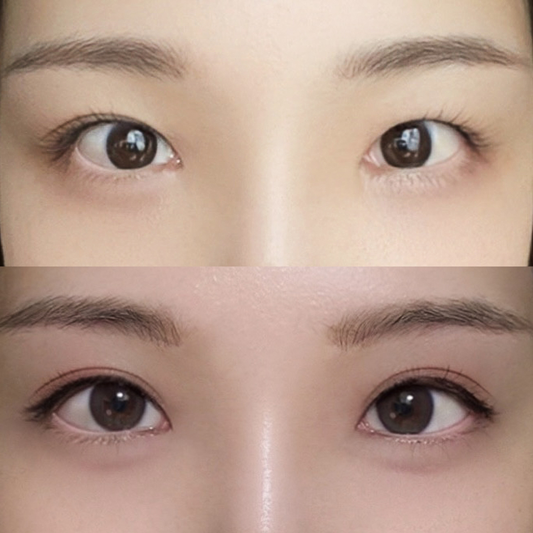 풀린눈재수술 쌍꺼풀재수술+눈매교정+뒤밑트임
