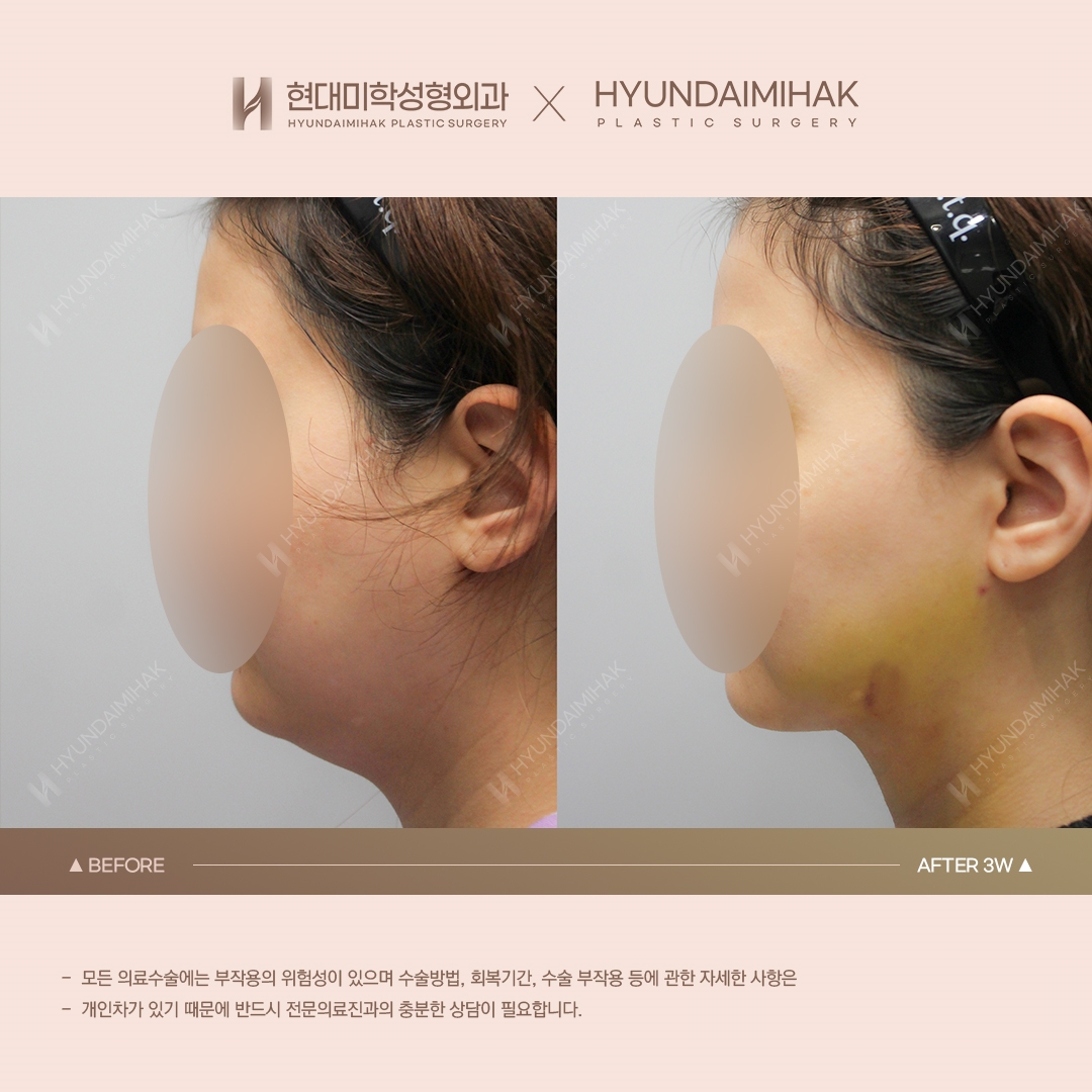 [리프팅] 이중턱 실리프팅 3주차