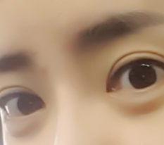 눈 수술 완전 만족스러워요!