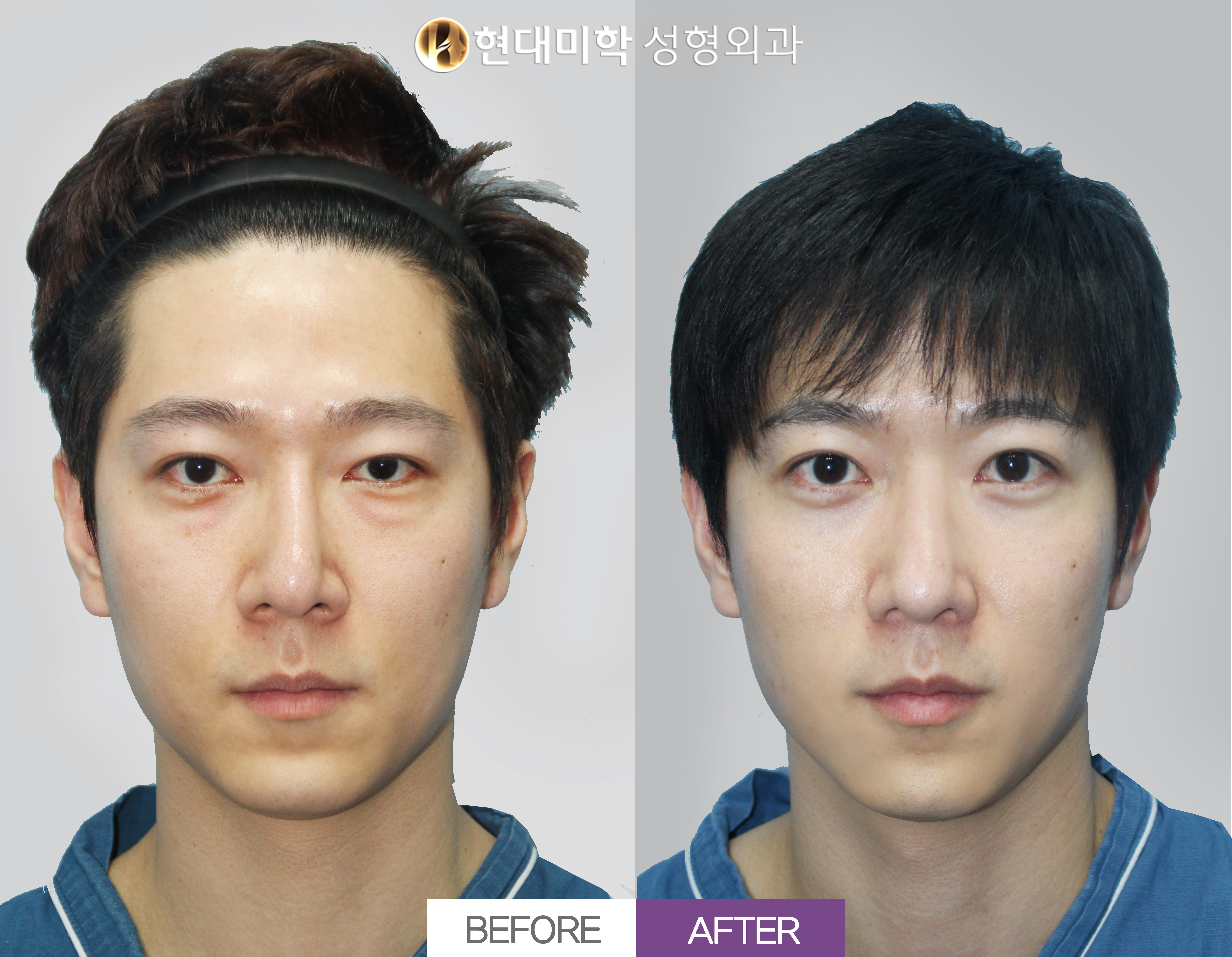 남자코 재수술 1개월차
