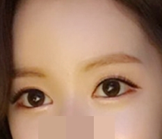 눈트임하고 예뻐졌어요