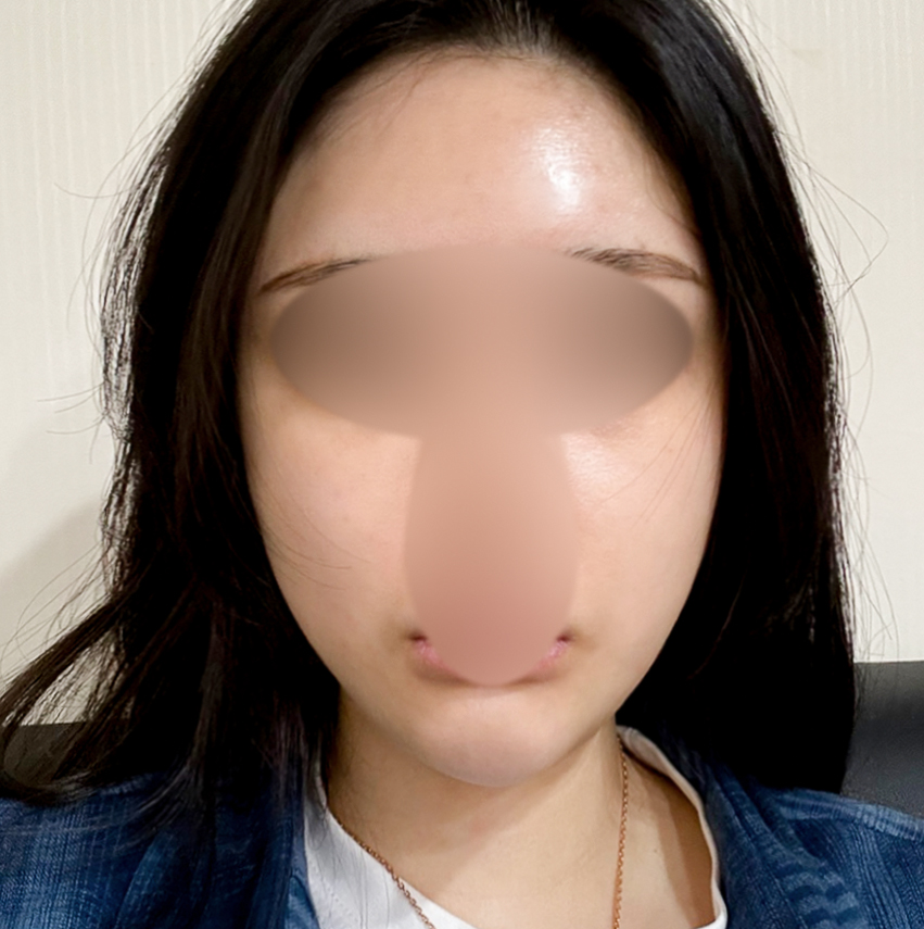 불독살, 팔자주름, 얼굴형 정리✨ 실리프팅 후기