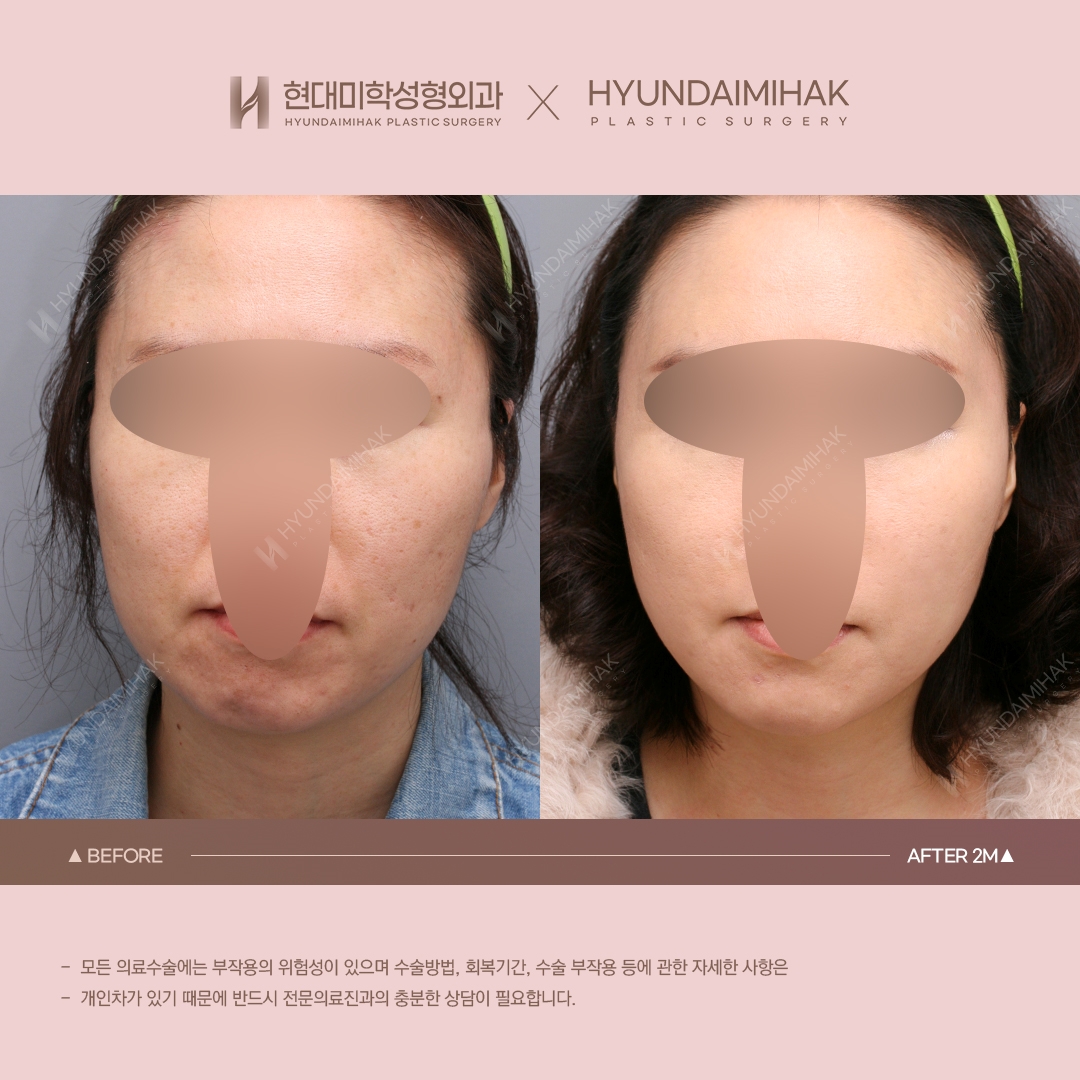 [동안성형] 실리프팅 2개월 차