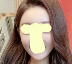 광대 5개월 지난 후기 올려요~!