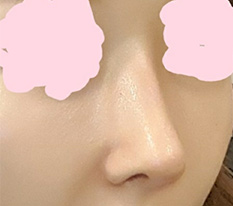 코수술한거 동네방네 자랑하고 다녀용 ㅎㅎ