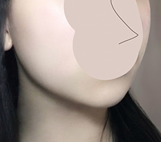 실리프팅 효과 굳굳입니당