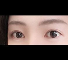 짝눈 라인 낮추기 쌍수재수술