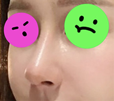 코수술한지 한달 지나서 완전 만족 중^^
