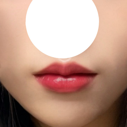 현대미학에서 입술성형했어요