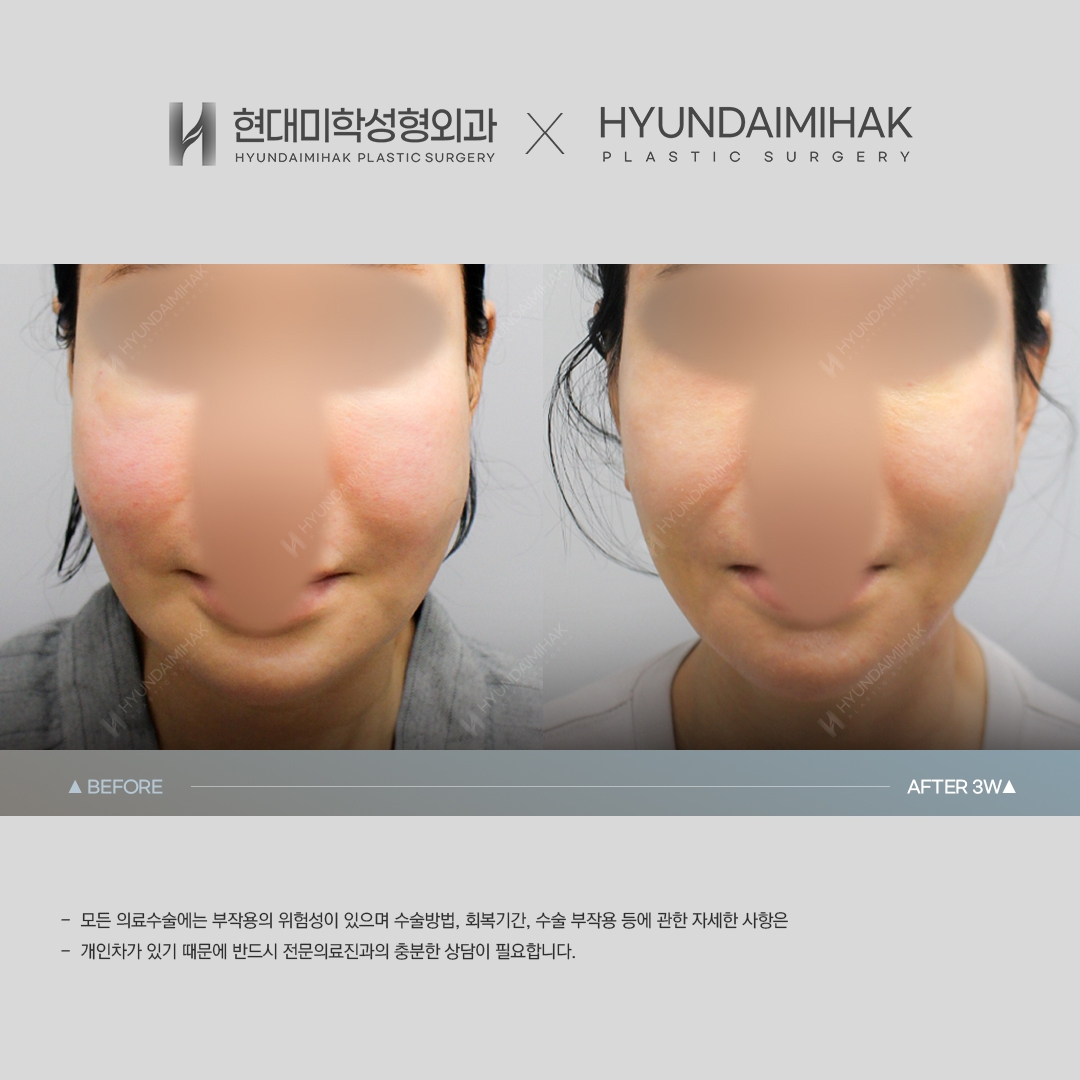 [동안성형] 실리프팅 3주 차