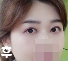 성공적인 눈재수술^^