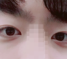 쌍커풀 절개 했습니답