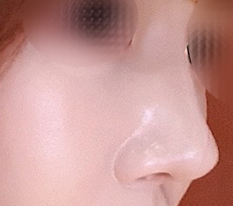 코재수술이구요 이번엔 자가늑으로 했습니다
