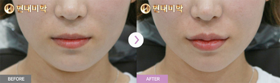 입술필러