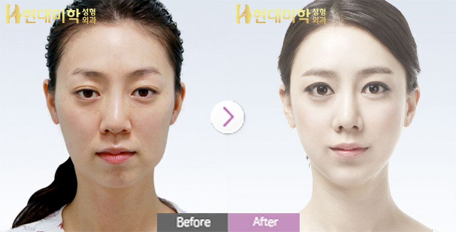 눈매교정, 밑트임, 코성형, 지방이식, 사각턱, 광대