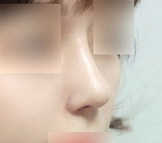 코 오똑해졌어요ㅎㅎ