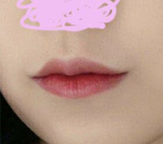 입꼬리수술 모양도 흉터도 너무 만족스럽네용 ㅎㅎ