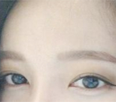 눈성형 후기☆.☆