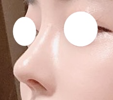 코성형 덕분에 예뻐졌단 소리 엄청듣고 지내네요