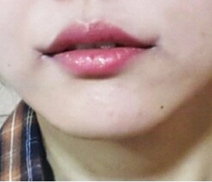 입꼬리수술 신기해요!!