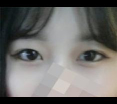눈수술 강추에요!