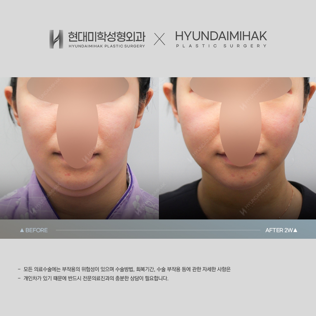 [리프팅] 이중턱 실리프팅 2주 차