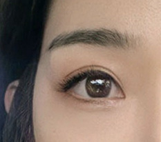 저한테 마지막 기회였는데 눈재수술 결국 성공했어요 ㅎ