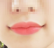 입꼬리수술했져욘