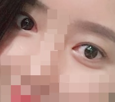 눈재수술+눈매교정