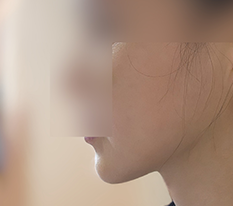 실리프팅 드디어