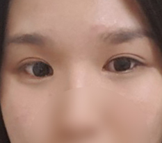 꼬막눈 대탈출!! 황호원장님 감사합니다!!