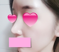 코 재수술 후기~~