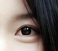 저 눈재수술 성공한거 맞죠?? ㅎㅎ