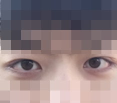 갖고 싶었던 쌍꺼풀