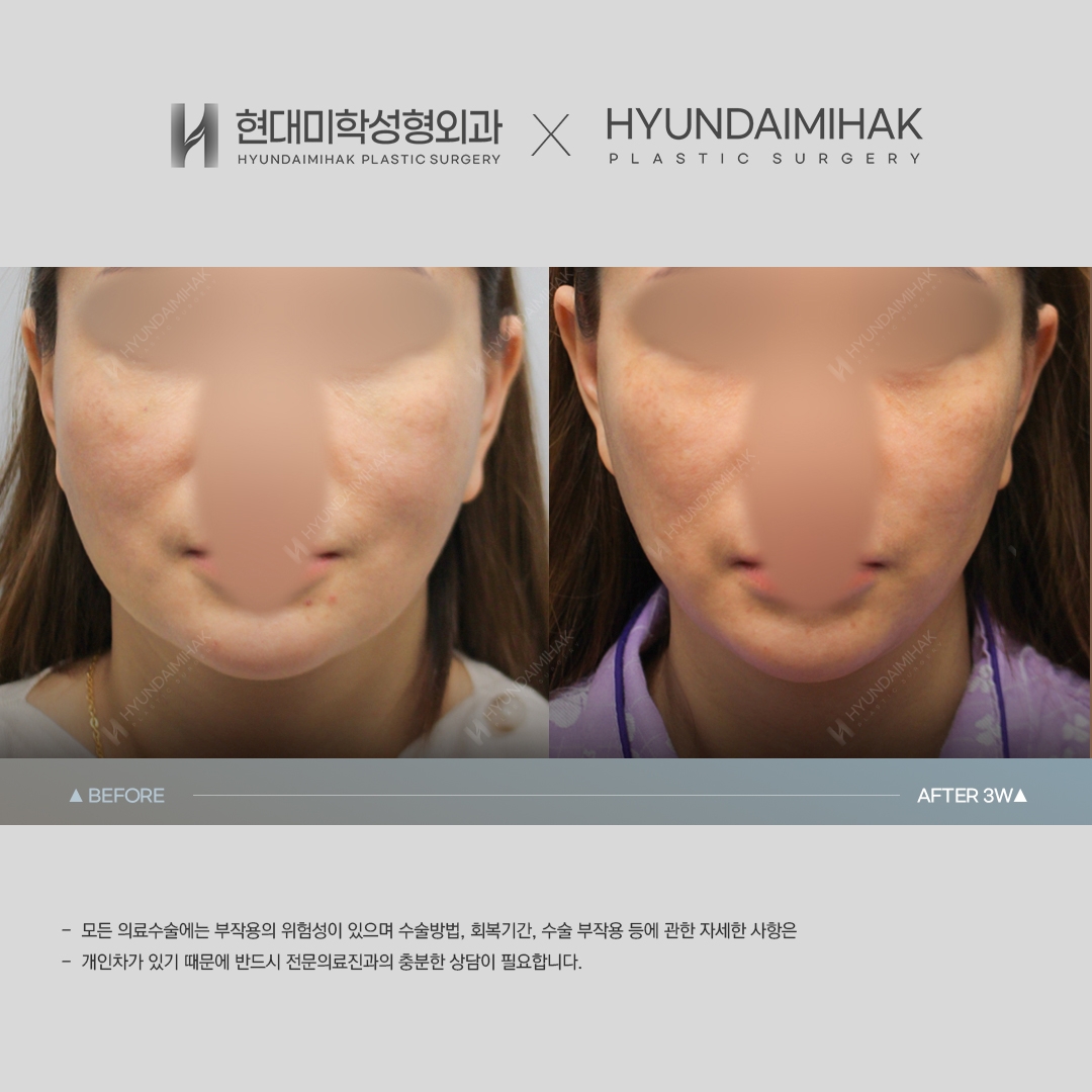 [동안성형] 실리프팅 3주 차